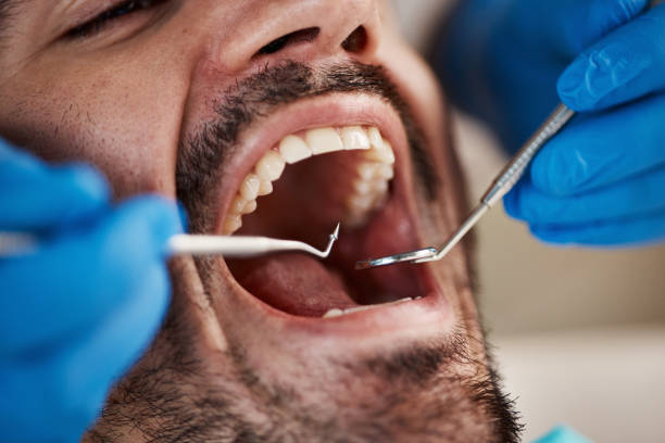 Best Broken or Cracked Tooth Emergency Dentist in Goshen, IN