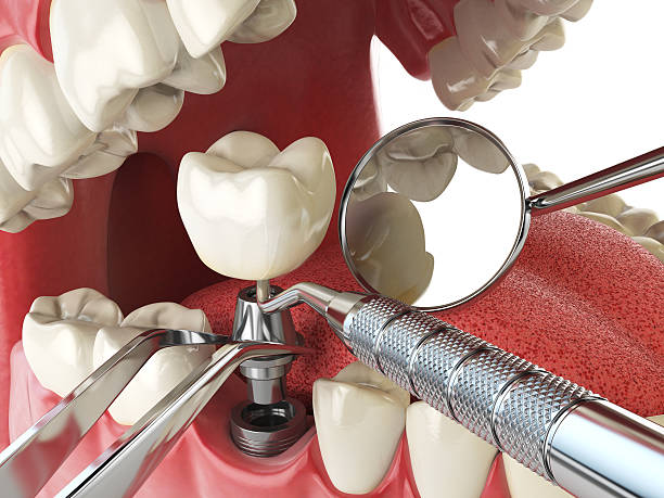 Best Emergency Root Canal Treatment in Goshen, IN
